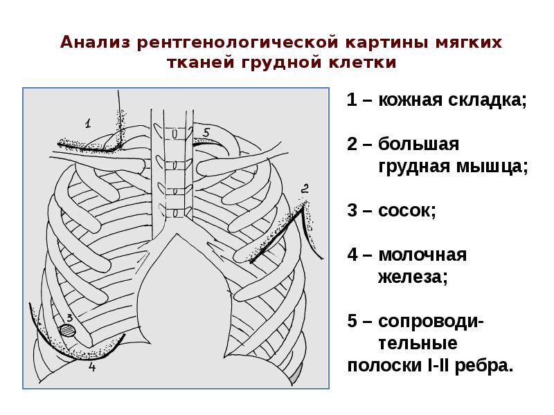 Обзорная органов грудной клетки. Анализ рентгенологической картины мягких тканей грудной клетки. Мягкие ткани грудной клетки. Проекция органов грудной клетки на ее переднюю поверхность. Анализ мягких тканей грудной клетки на рентгенограмме.