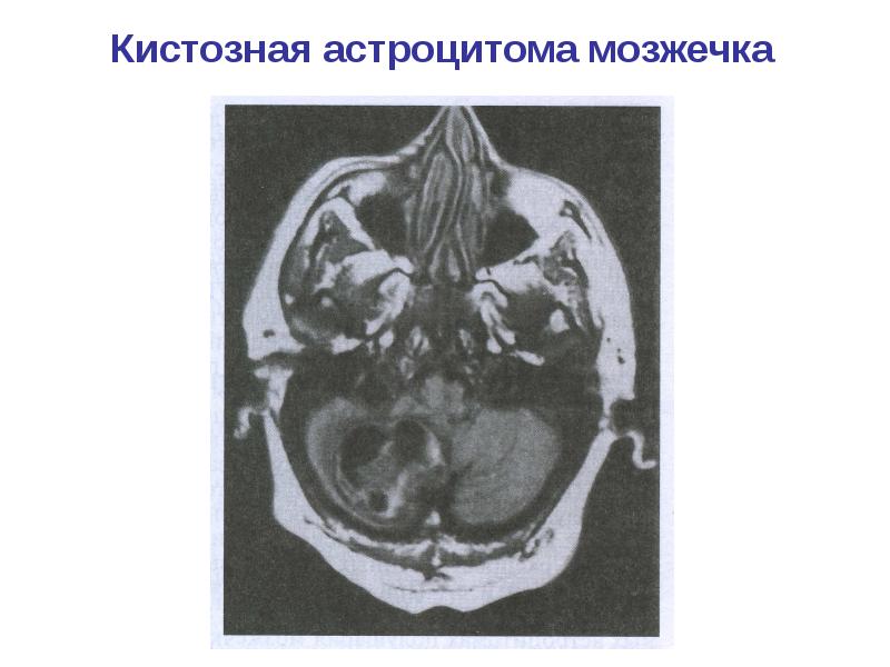 Опухоли головного и спинного мозга презентация