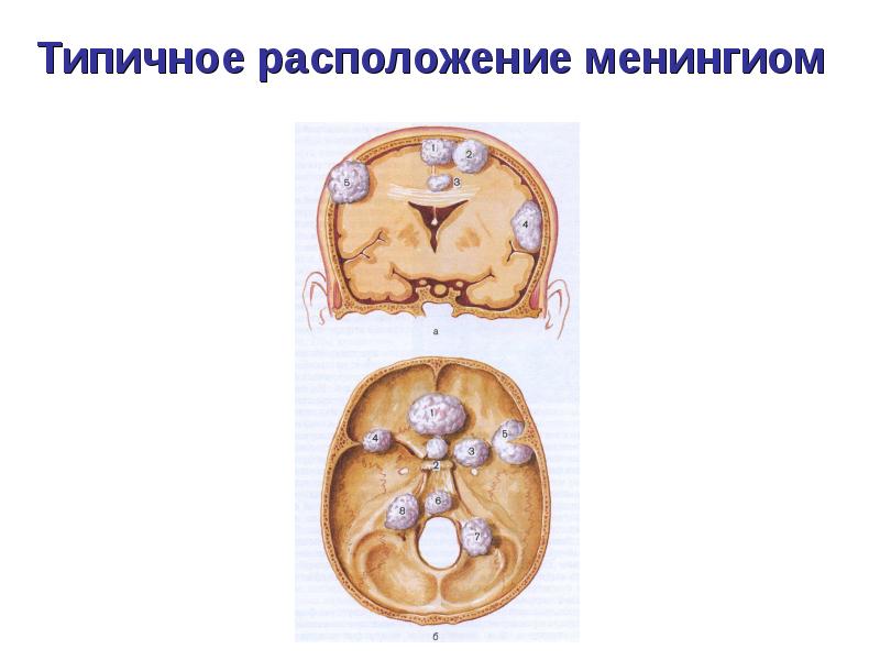 Опухоли головного и спинного мозга презентация