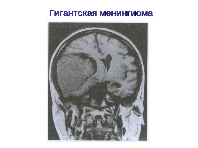 Опухоли головного и спинного мозга презентация