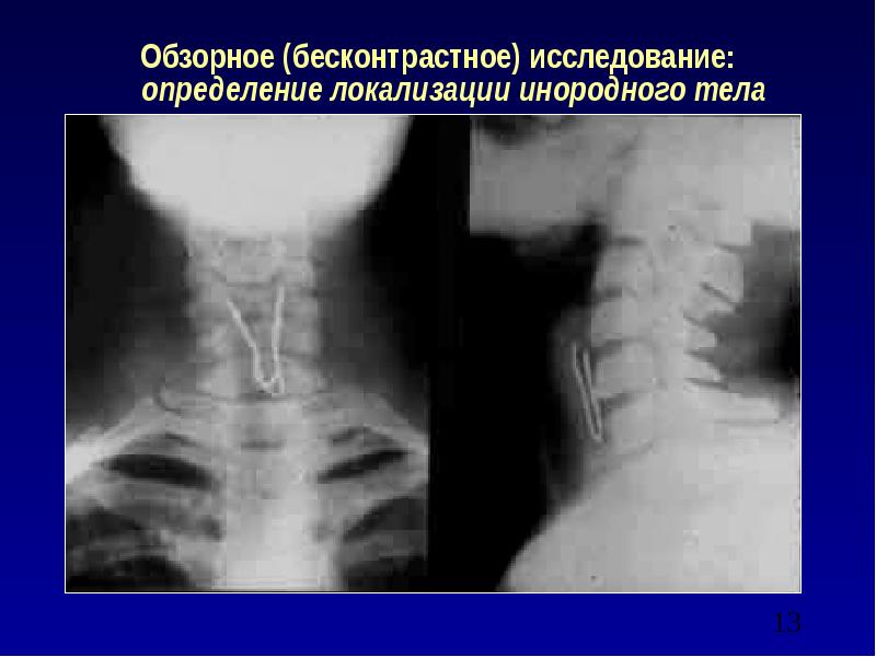 Презентация инородные тела жкт