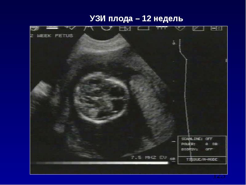Фото плода в 12 недель беременности на узи