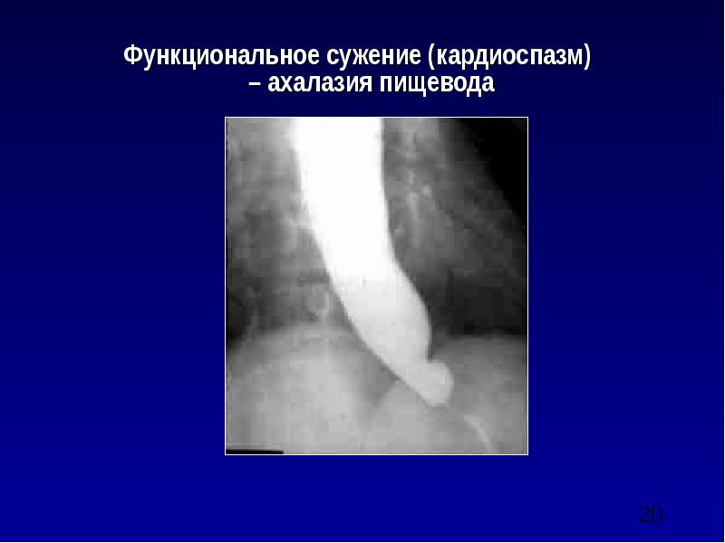 Какой из перечисленных симптомов является ведущим в рентгенологической картине ахалазии пищевода