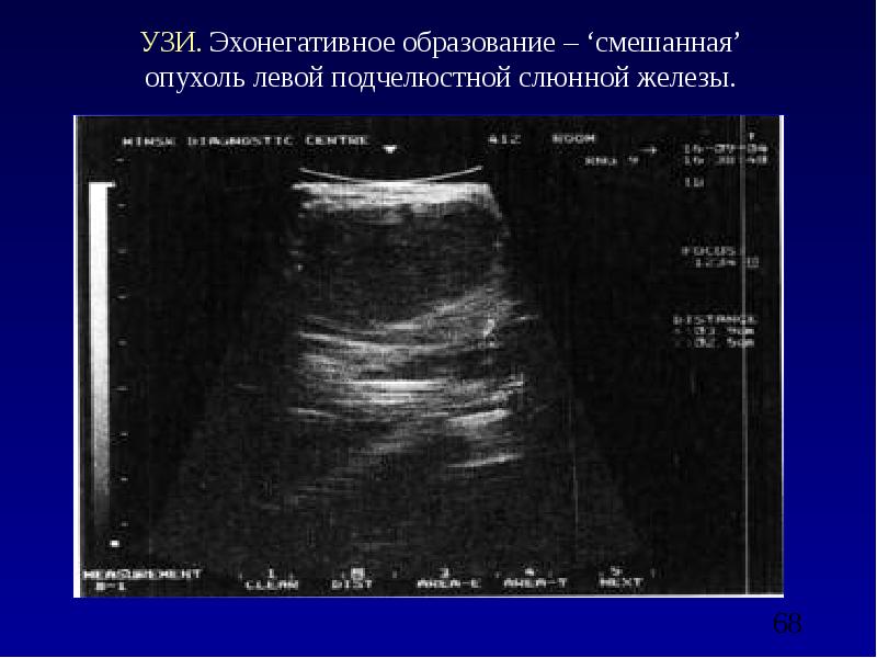 Образец протокола узи слюнных желез