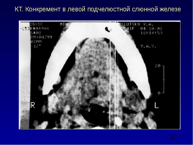 Лучевая терапия при раке слюнных желез