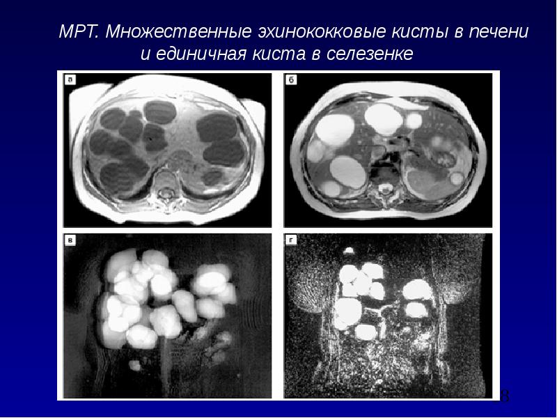 Эхинококковая киста печени кт картина