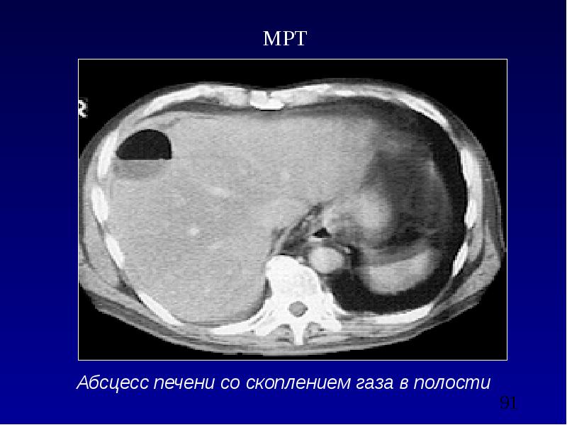 Абсцесс брюшной полости презентация