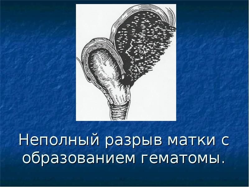 Матка 2 степени. Неполный разрыв матки с образованием гематомы. Частичный разрыв матки.