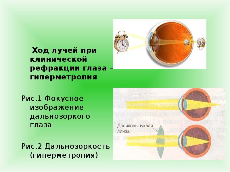 Рефракция глаза презентация