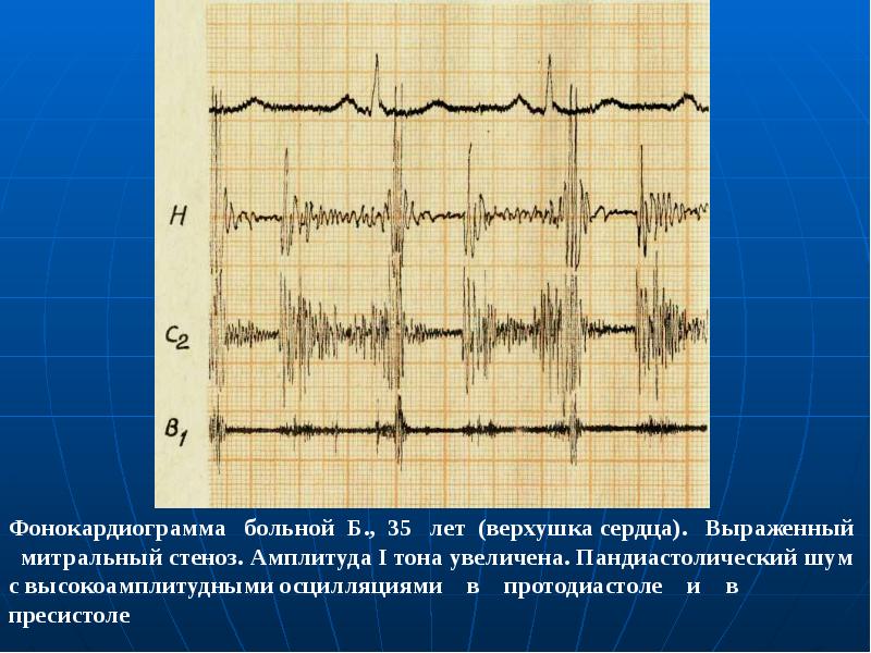 Ниже представлена фотография фрагмента электрокардиограммы и увеличенный снимок одного из сердечных