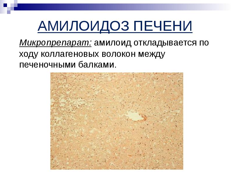 Амилоидоз препарат. Амилоидоз препарат