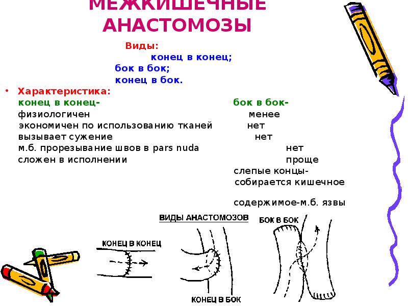 Анастомоз конец в конец схема