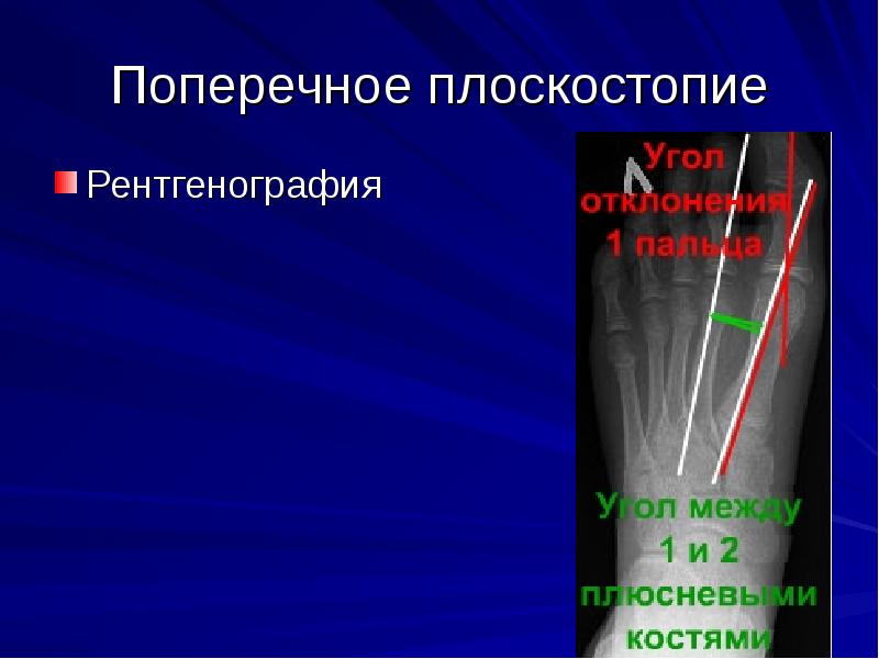 Плоскостопие рентген схема