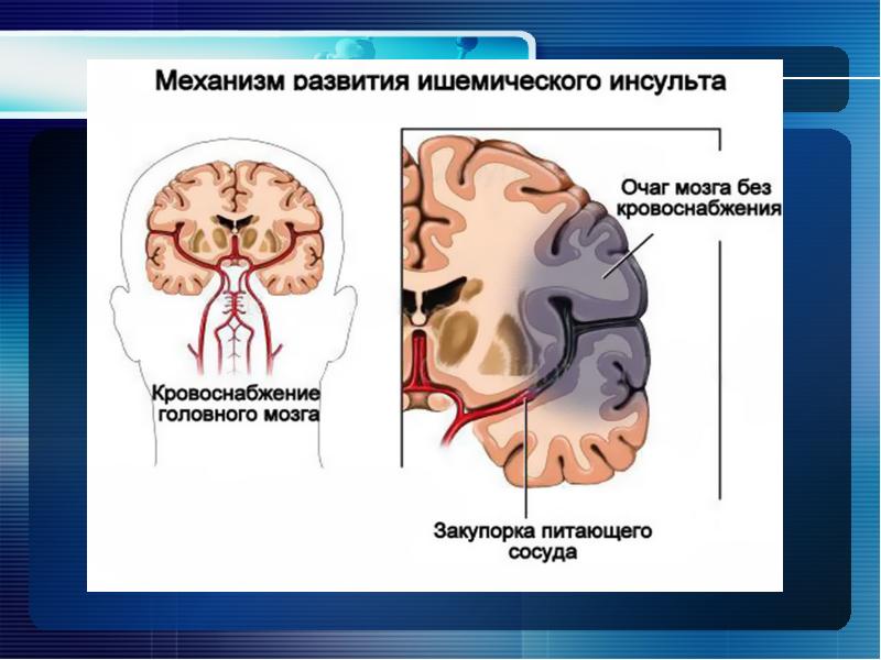 Клиническая картина ишемического инсульта