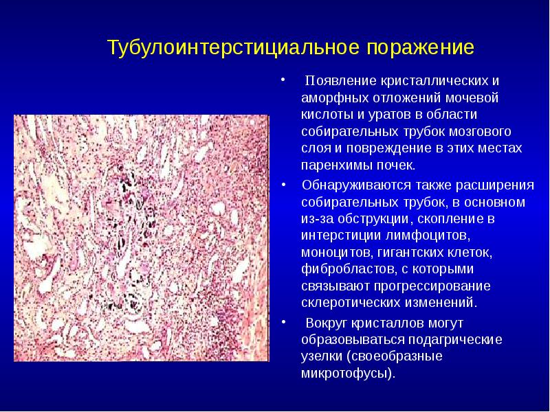 Тубулоинтерстициальное поражение  Появление кристаллических и аморфных отложений мочевой кислоты и