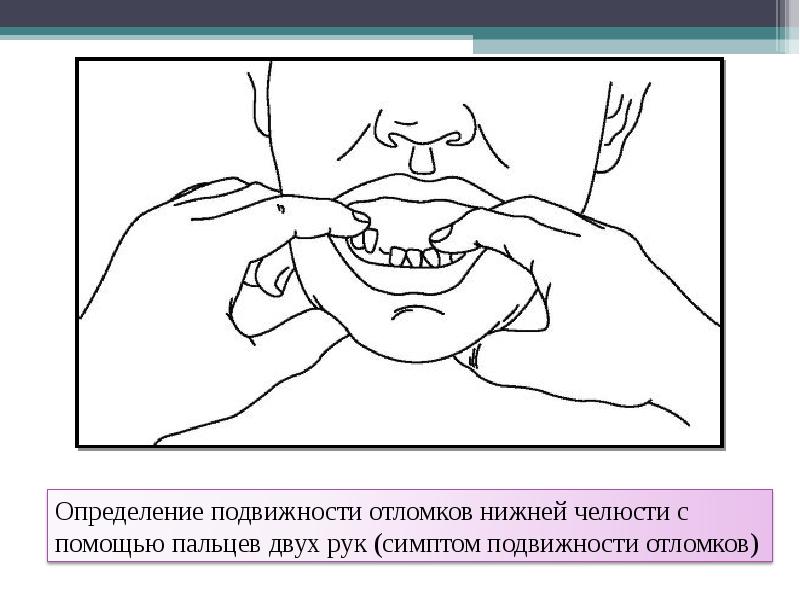 Клиническая картина при переломах нижней челюсти