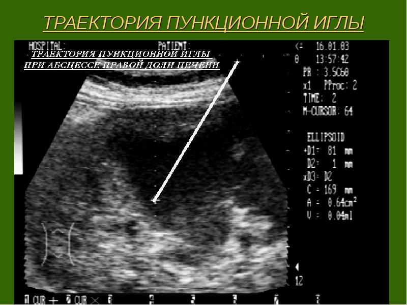 Опухоли гепатопанкреатодуоденальной зоны презентация