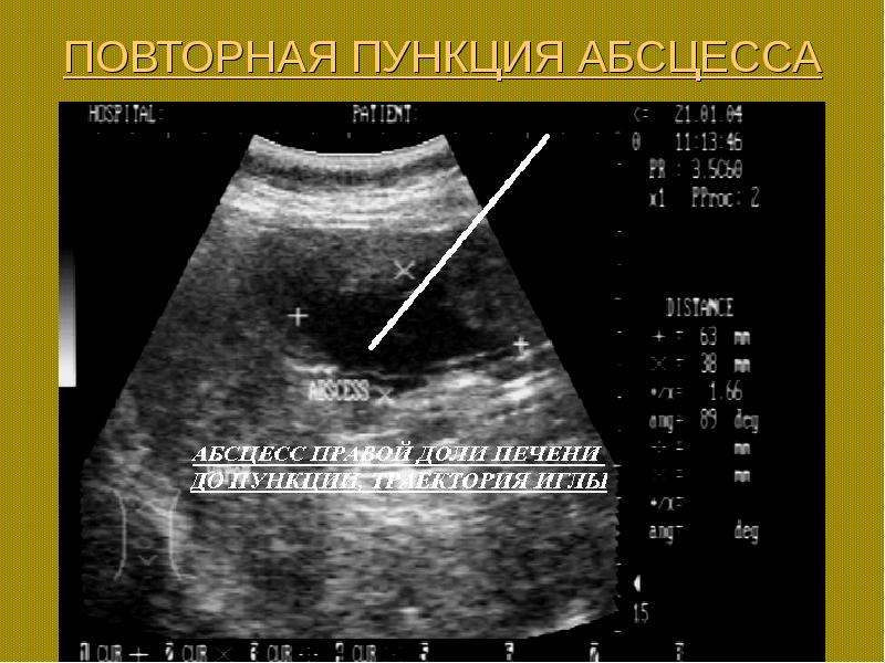 Опухоли гепатопанкреатодуоденальной зоны презентация