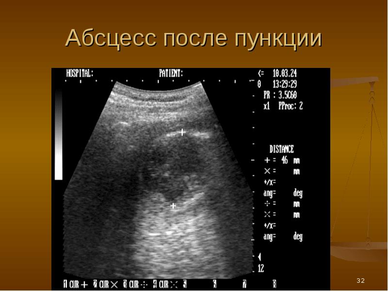 Опухоли гепатопанкреатодуоденальной зоны презентация