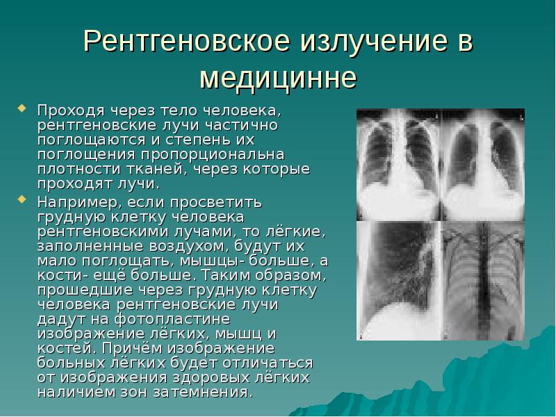 В чем смысл рентгенографии с прямым увеличением рентгеновского изображения