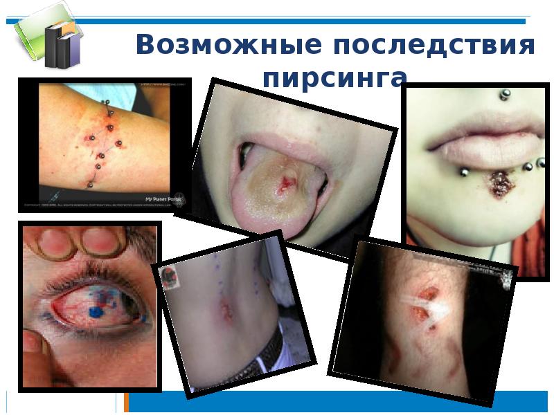 Возможные последствия пирсинга Возможные последствия пирсинга
