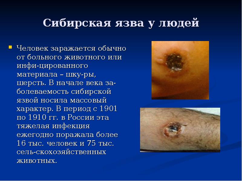 Сибирская язва у людей Человек заражается обычно от больного животного или