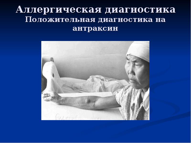 Аллергическая диагностика Положительная диагностика на антраксин