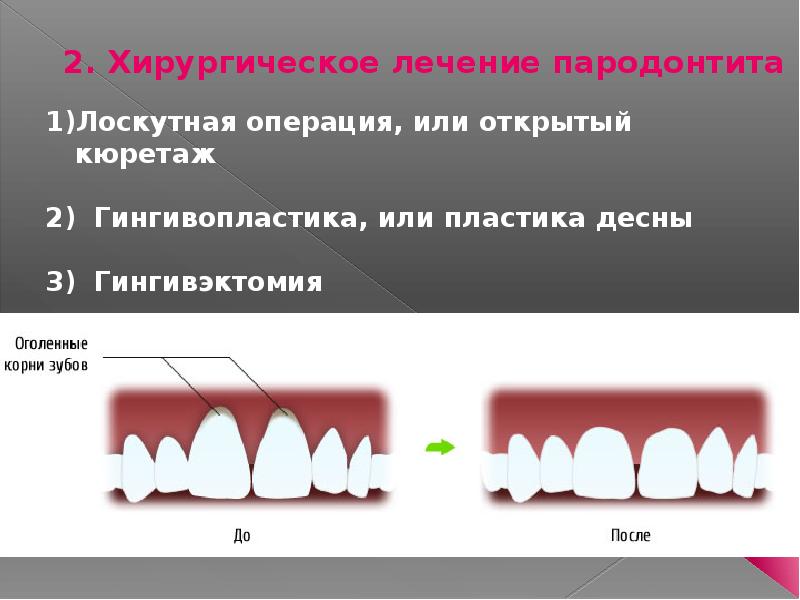 Ортопедические методы лечения генерализованного пародонтита презентация