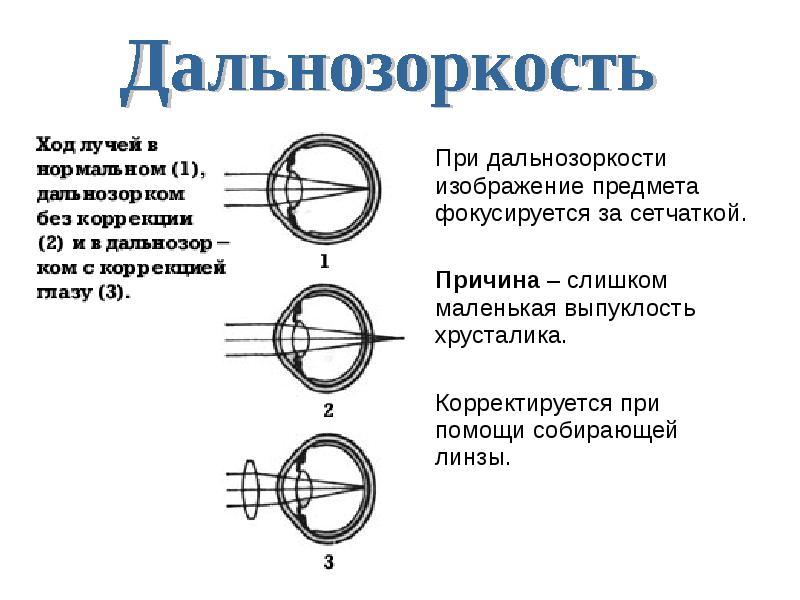 Если изображение фокусируется перед сетчаткой глаза то возникает