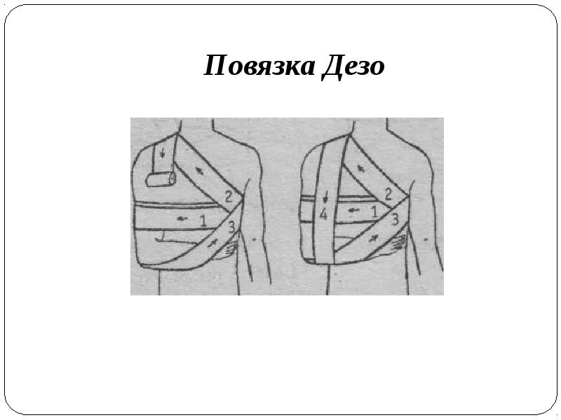 Дезо повязка на плечевой схема