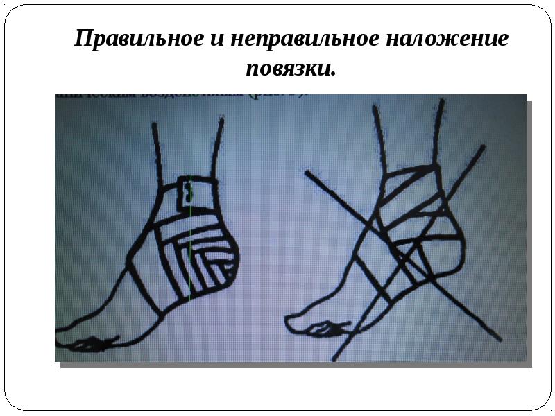 Правильное и неправильное наложение повязки. Правильное и неправильное наложение повязки.
