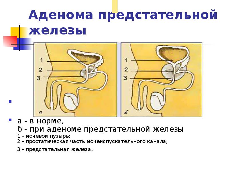 Скачать Массаж Простаты