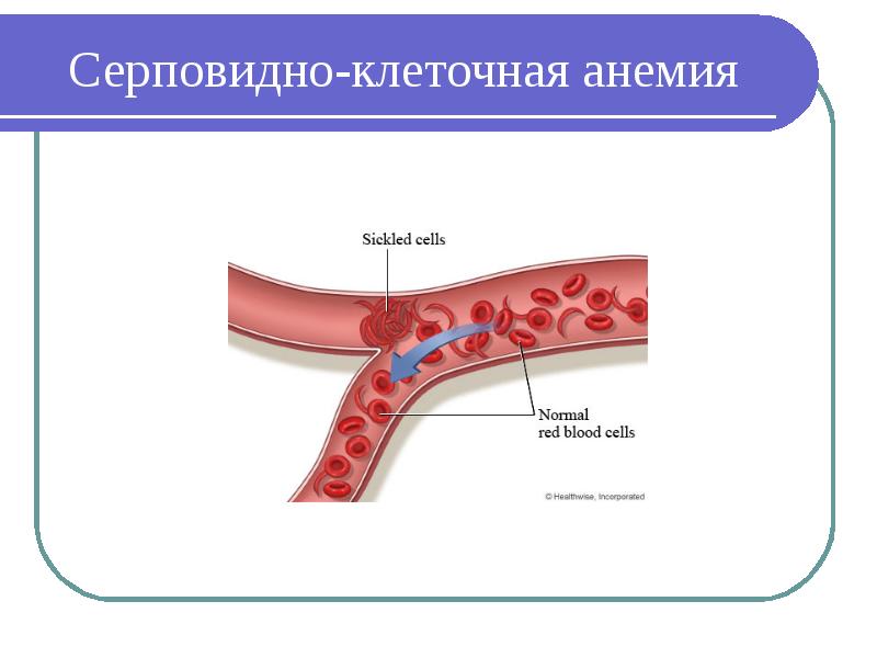 Серповидноклеточная анемия презентация