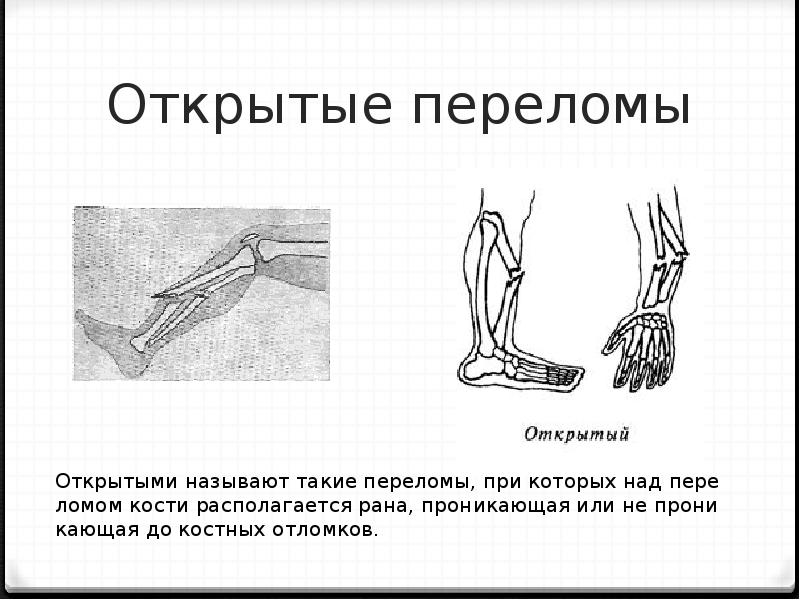 Какой вид травмы показан на рисунке какие кости повреждены