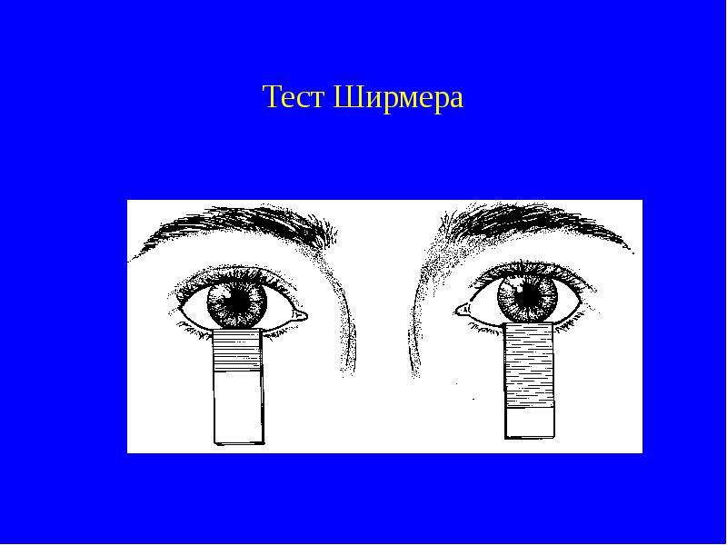 Тест ширмера. Проба Ширмера подготовка. Проба Ширмера в офтальмологии. Тест Ширмера в офтальмологии.