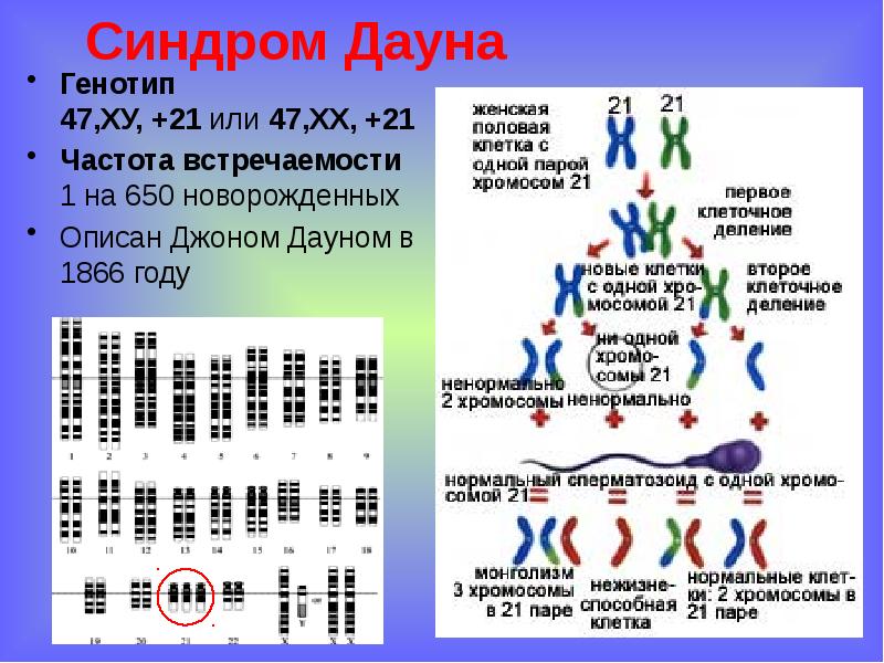 Синдром дауна презентация по генетике