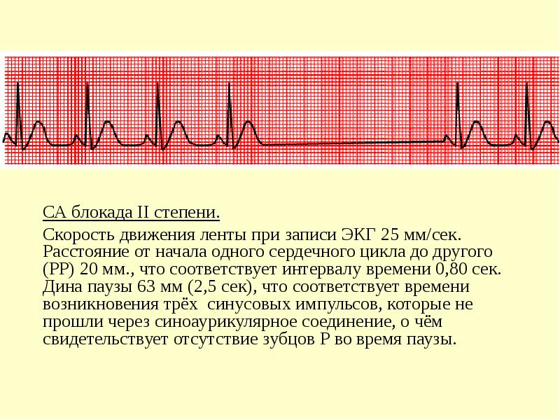 Блокада сердца что это простыми словами