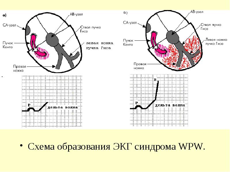 Синдром впв презентация