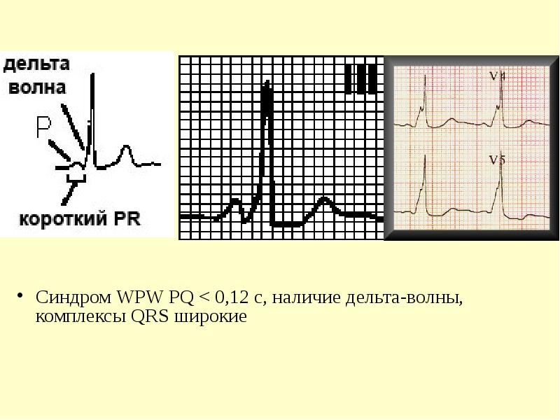 Синдром впв презентация