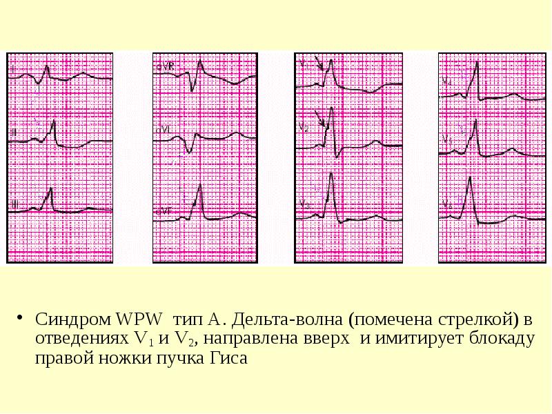 Wpw синдром презентация