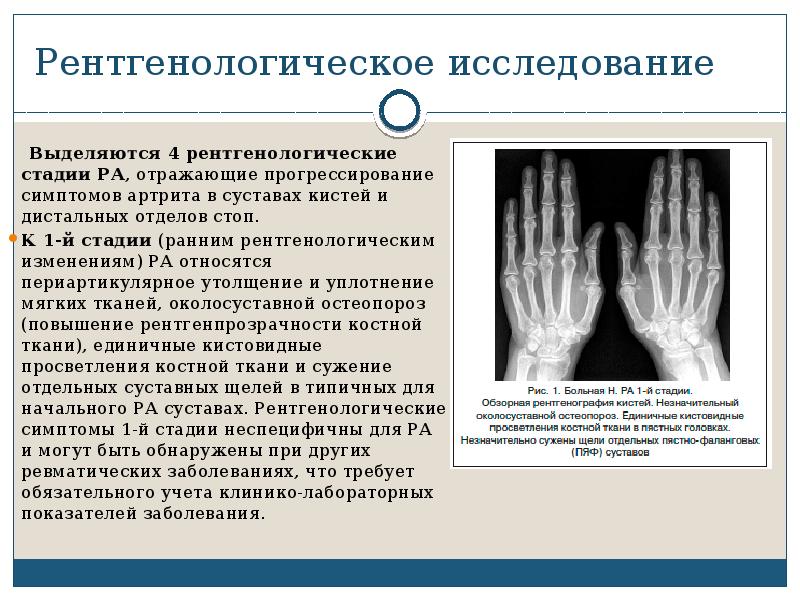 Ревматоидный артрит обследование