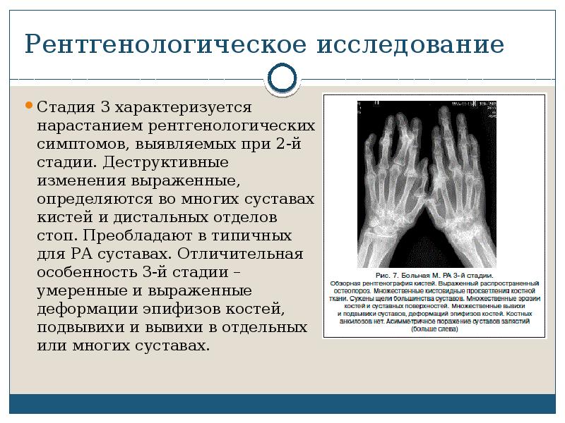 Псориатический артрит презентация по ревматологии