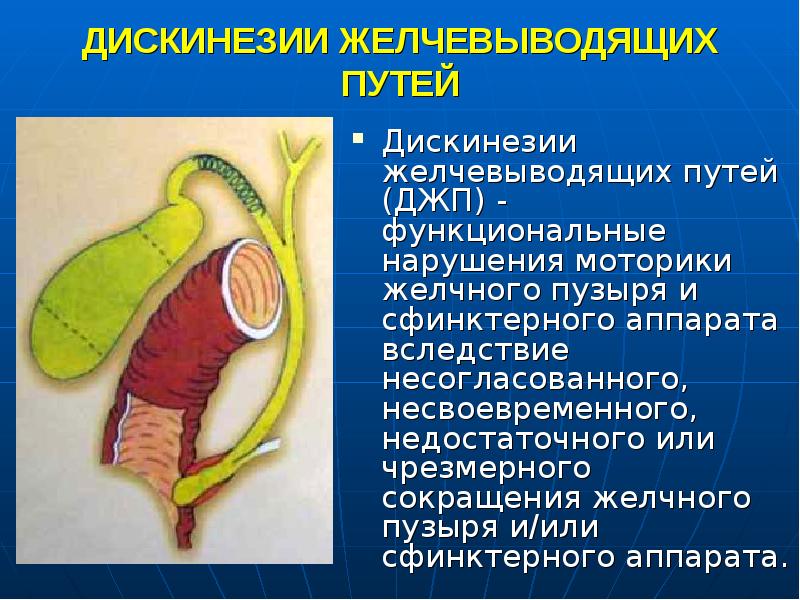 Дискинезия желчевыводящих путей у детей презентация