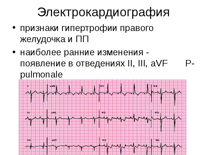 Гипертрофия желудочков на экг