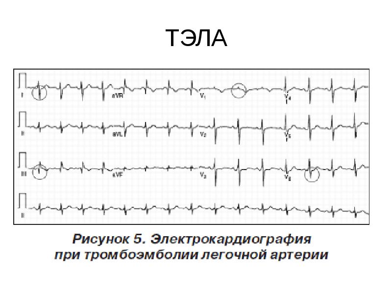 Тэла экг картина