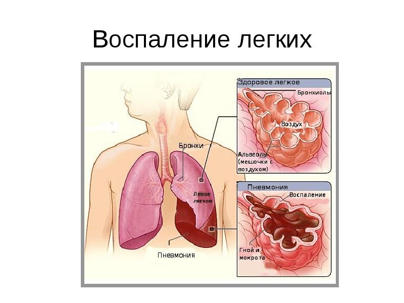 Виды пневмонии. Пневмония воспаление легких.