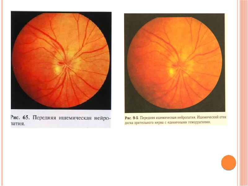 Нейропатия глаза. Передняя ишемическая оптиконейропатия зрительный нерв. Передняя ишемическая оптическая нейропатия глаза. Ишемическая нейропатия глазное дно. Ретробульбарный неврит и ишемическая нейропатия.