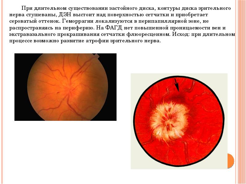 Нейропатия зрительных. Ишемическая нейропатия глазное дно. Передняя ишемическая невропатия зрительного нерва. Нейрооптикопатия зрительного нерва. Ишемическая нейропатия сетчатки.