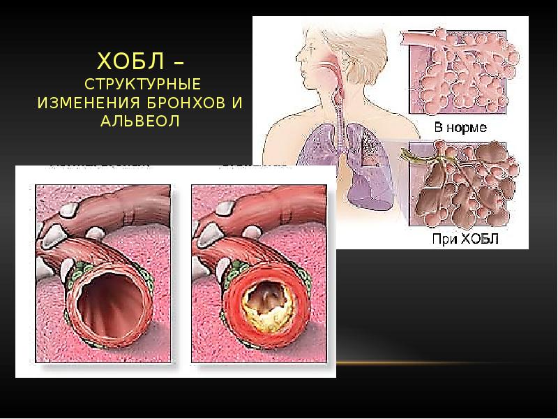 Легкие при хобл картинки