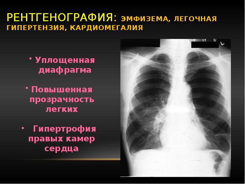 Рентген картина хронического бронхита